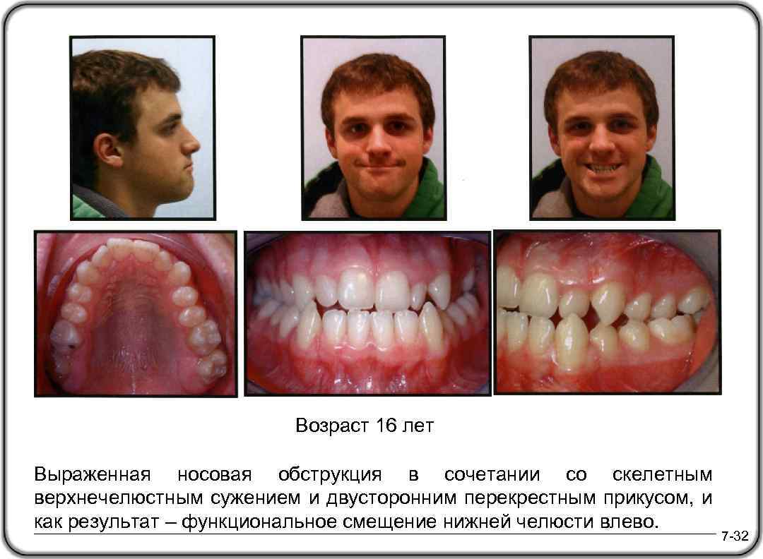 Перекрестный прикус схема лечения у взрослого