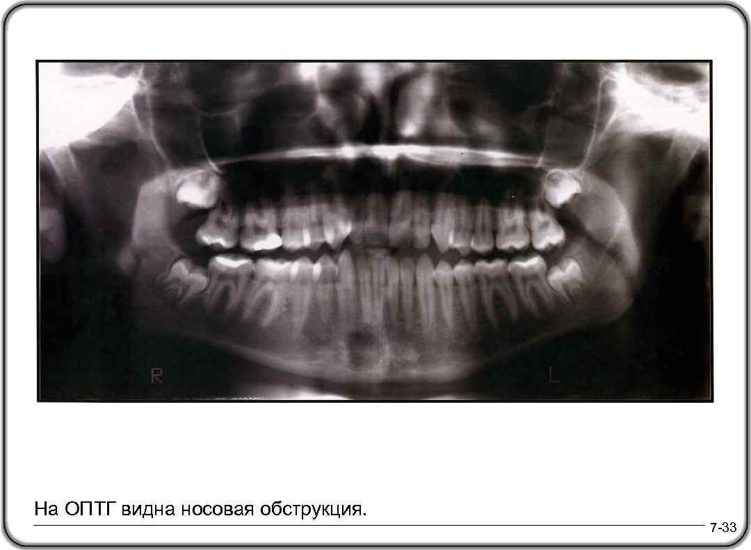 На ОПТГ видна носовая обструкция. 7 -33 