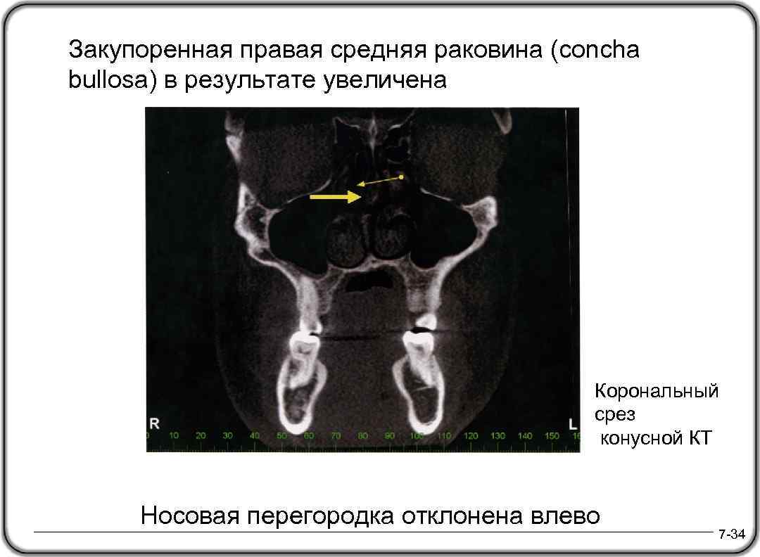 Закупоренная правая средняя раковина (concha bullosa) в результате увеличена Корональный срез конусной КТ Носовая