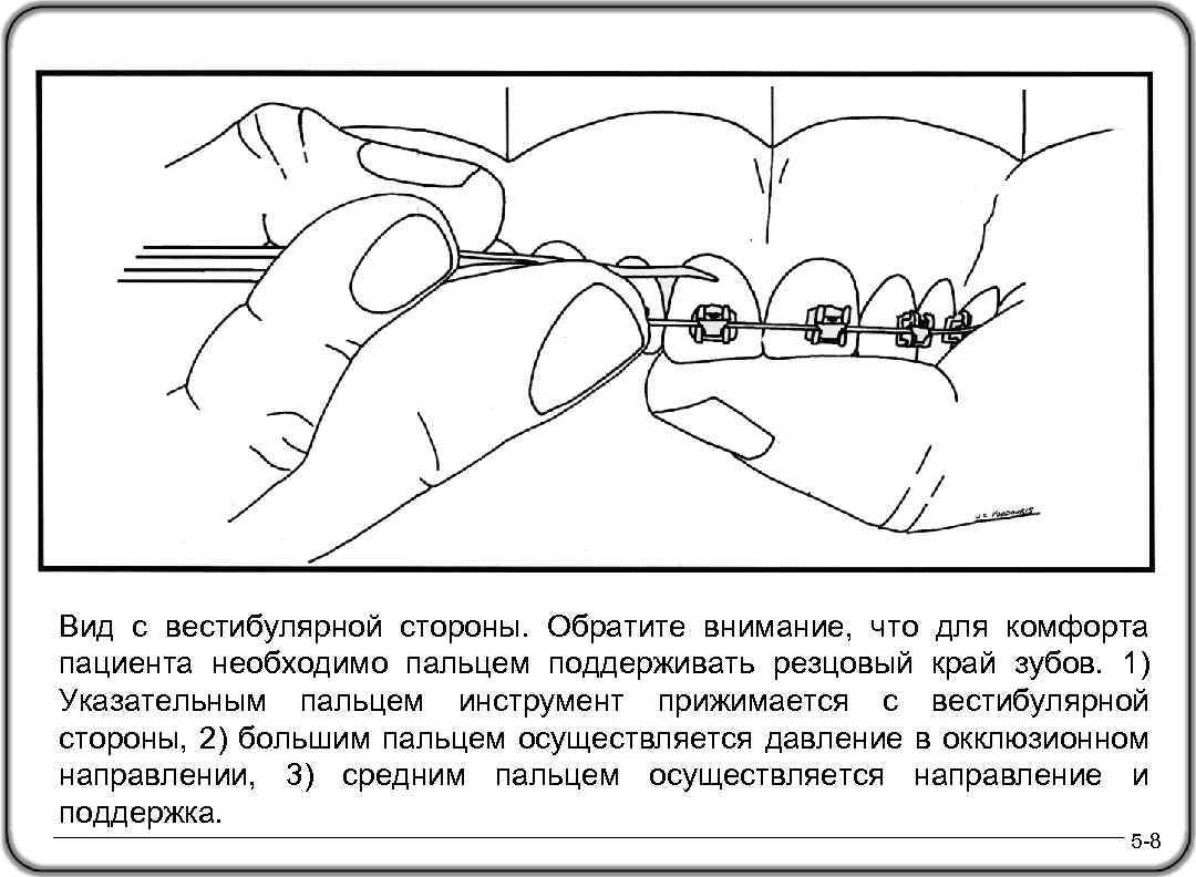 Вид с вестибулярной стороны. Обратите внимание, что для комфорта пациента необходимо пальцем поддерживать резцовый