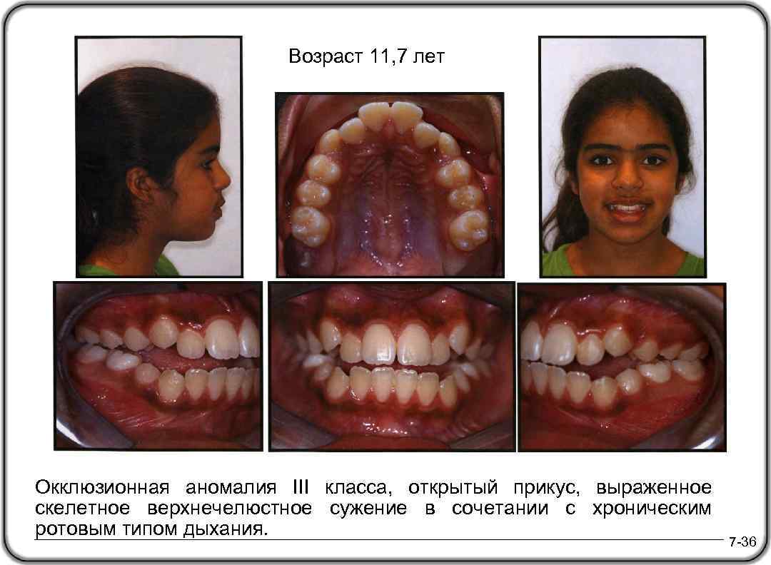 Возраст 11, 7 лет Окклюзионная аномалия III класса, открытый прикус, выраженное скелетное верхнечелюстное сужение