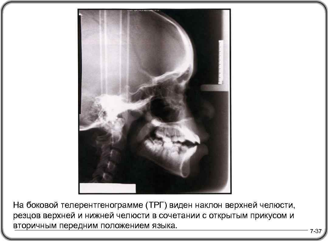 На боковой телерентгенограмме (ТРГ) виден наклон верхней челюсти, резцов верхней и нижней челюсти в