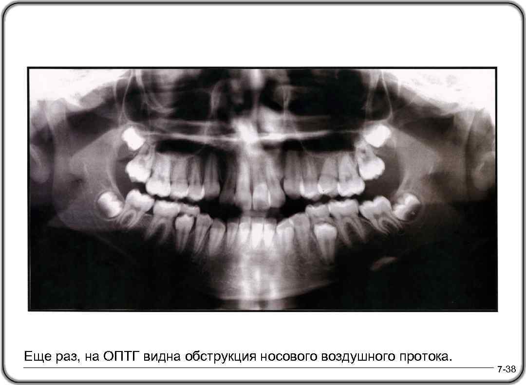 Еще раз, на ОПТГ видна обструкция носового воздушного протока. 7 -38 