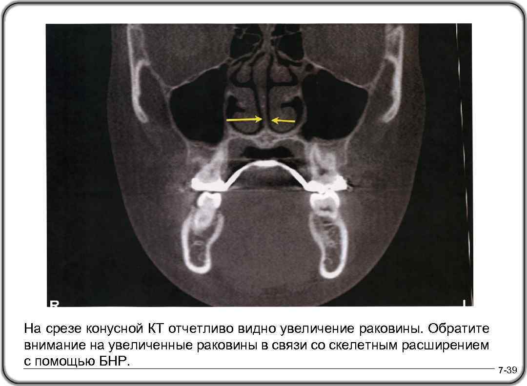 На срезе конусной КТ отчетливо видно увеличение раковины. Обратите внимание на увеличенные раковины в