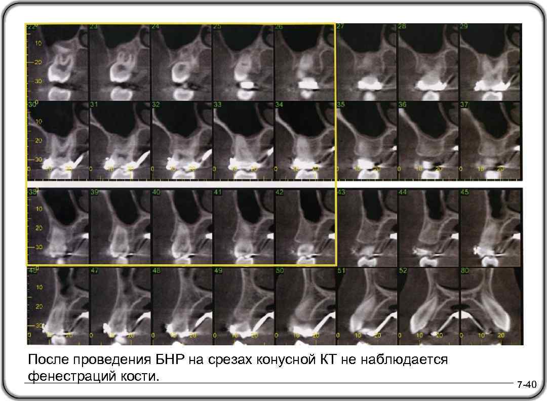 После проведения БНР на срезах конусной КТ не наблюдается фенестраций кости. 7 -40 