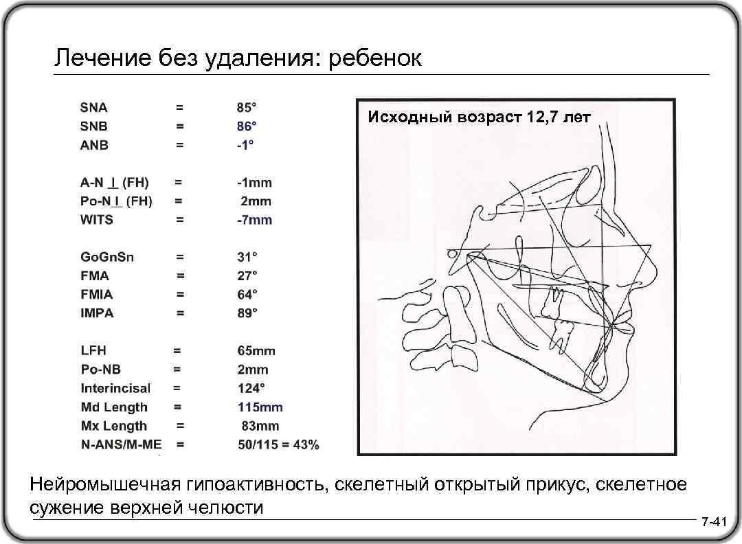 Лечение без удаления: ребенок Исходный возраст 12, 7 лет Нейромышечная гипоактивность, скелетный открытый прикус,