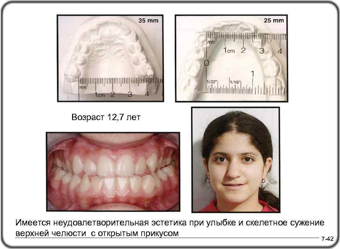 Возраст 12, 7 лет Имеется неудовлетворительная эстетика при улыбке и скелетное сужение верхней челюсти