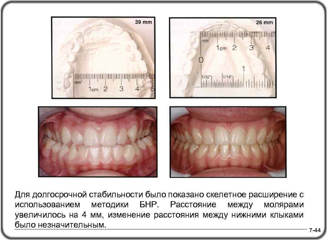 Для долгосрочной стабильности было показано скелетное расширение с использованием методики БНР. Расстояние между молярами