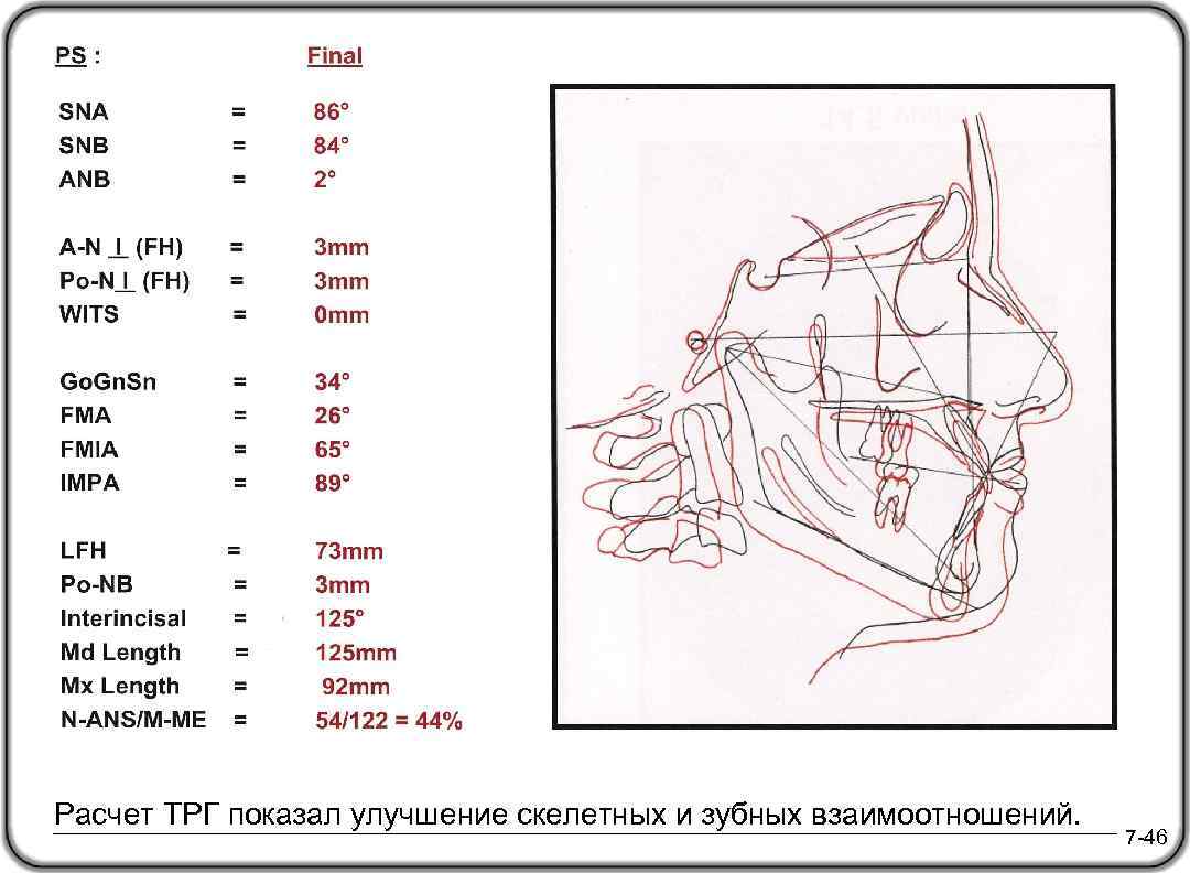 Finishing Stage Расчет ТРГ показал улучшение скелетных и зубных взаимоотношений. 7 -46 