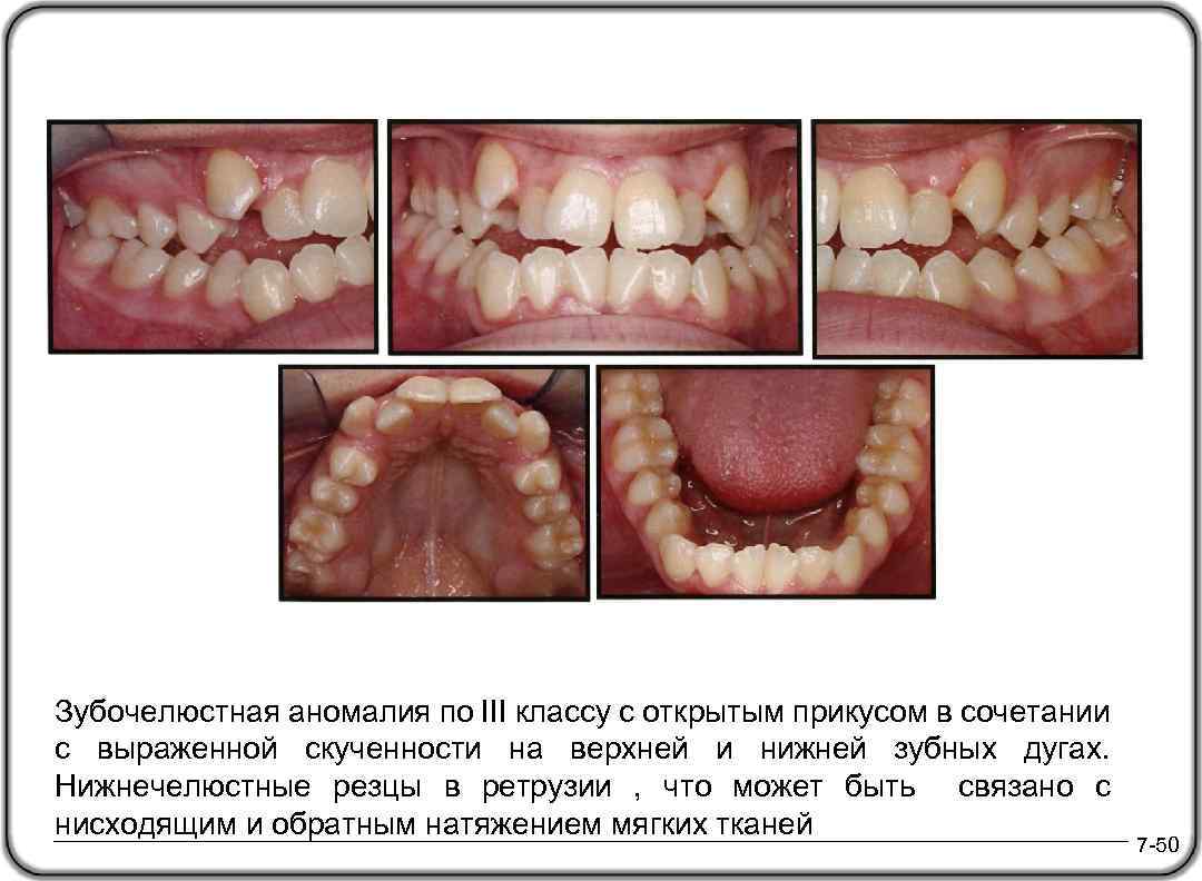 Зубочелюстная аномалия по III классу с открытым прикусом в сочетании с выраженной скученности на