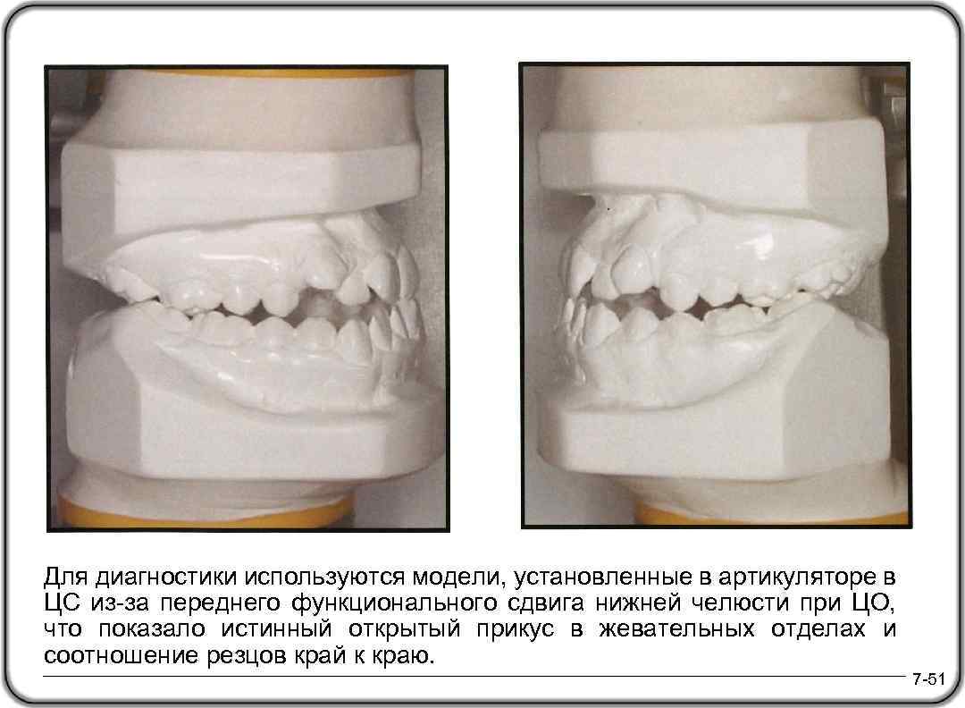 Для диагностики используются модели, установленные в артикуляторе в ЦС из-за переднего функционального сдвига нижней