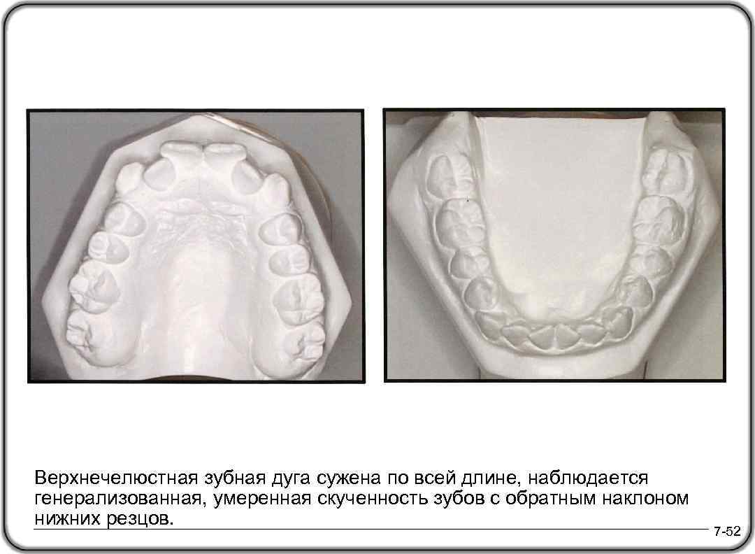 Верхнечелюстная зубная дуга сужена по всей длине, наблюдается генерализованная, умеренная скученность зубов с обратным