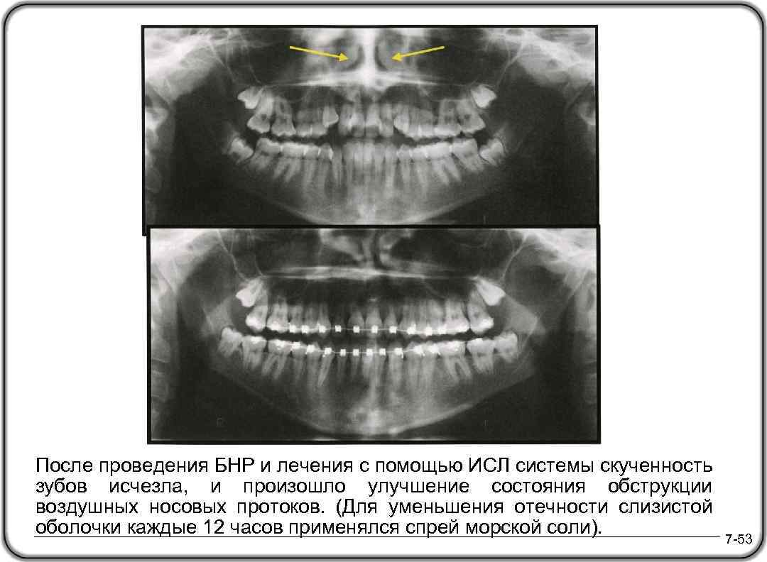 После проведения БНР и лечения с помощью ИСЛ системы скученность зубов исчезла, и произошло