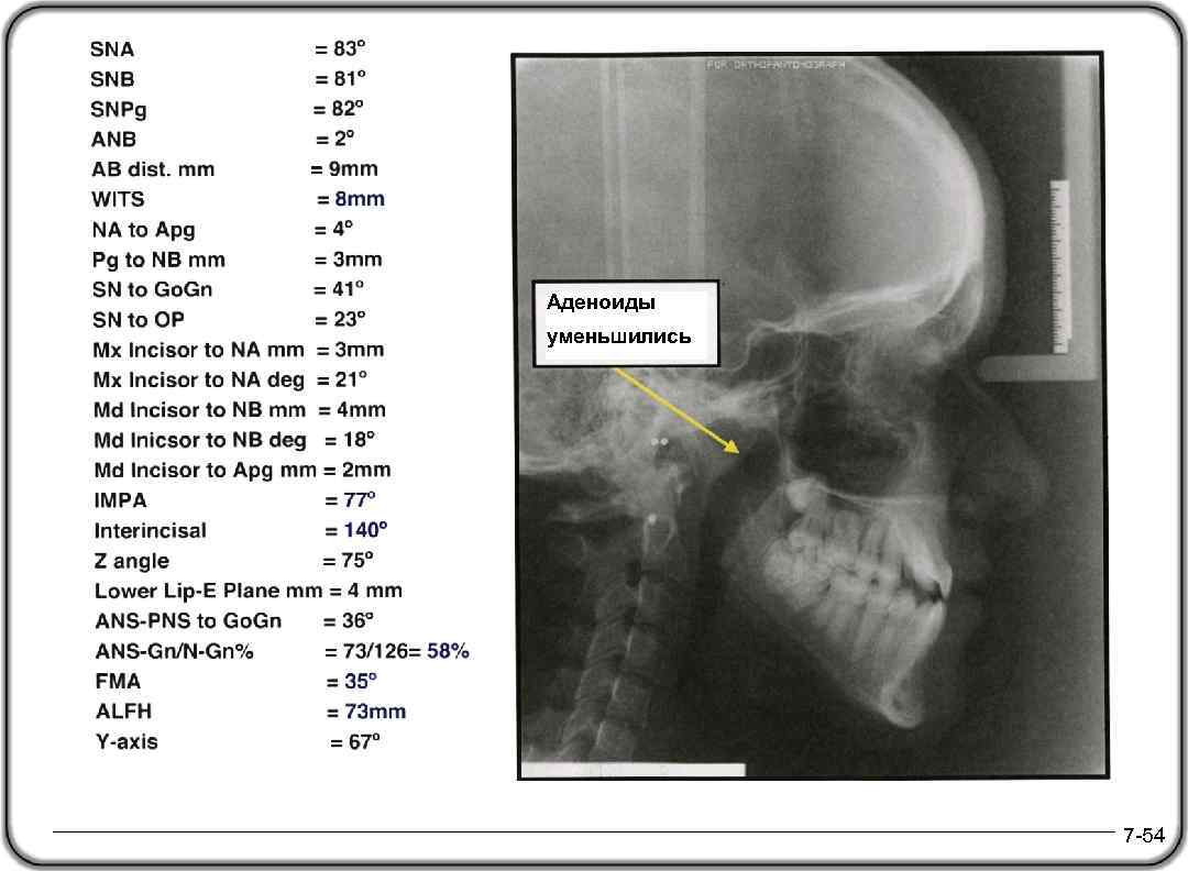 Аденоиды уменьшились 7 -54 