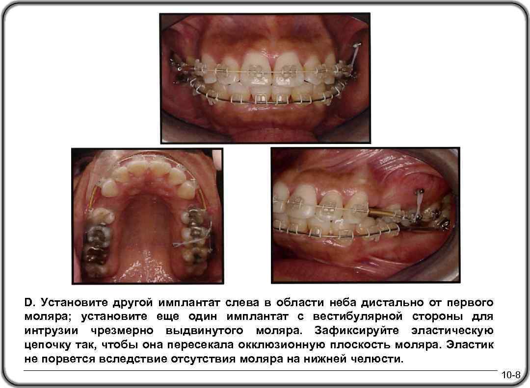 D. Установите другой имплантат слева в области неба дистально от первого моляра; установите еще