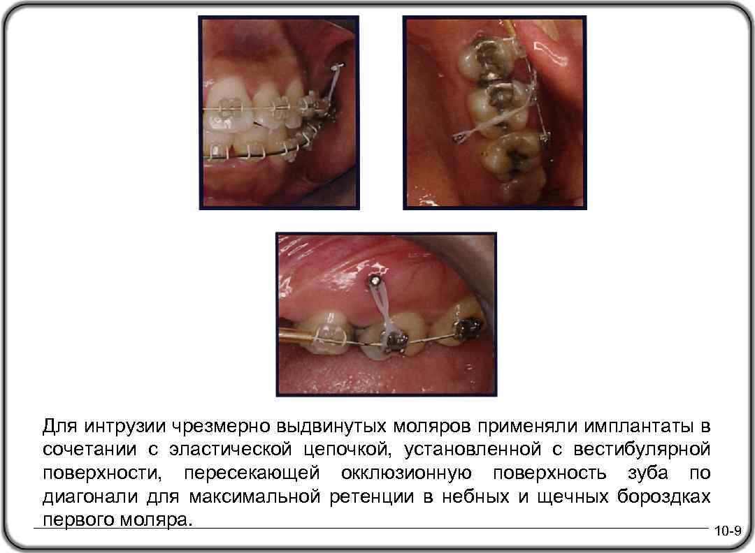 Для интрузии чрезмерно выдвинутых моляров применяли имплантаты в сочетании с эластической цепочкой, установленной с