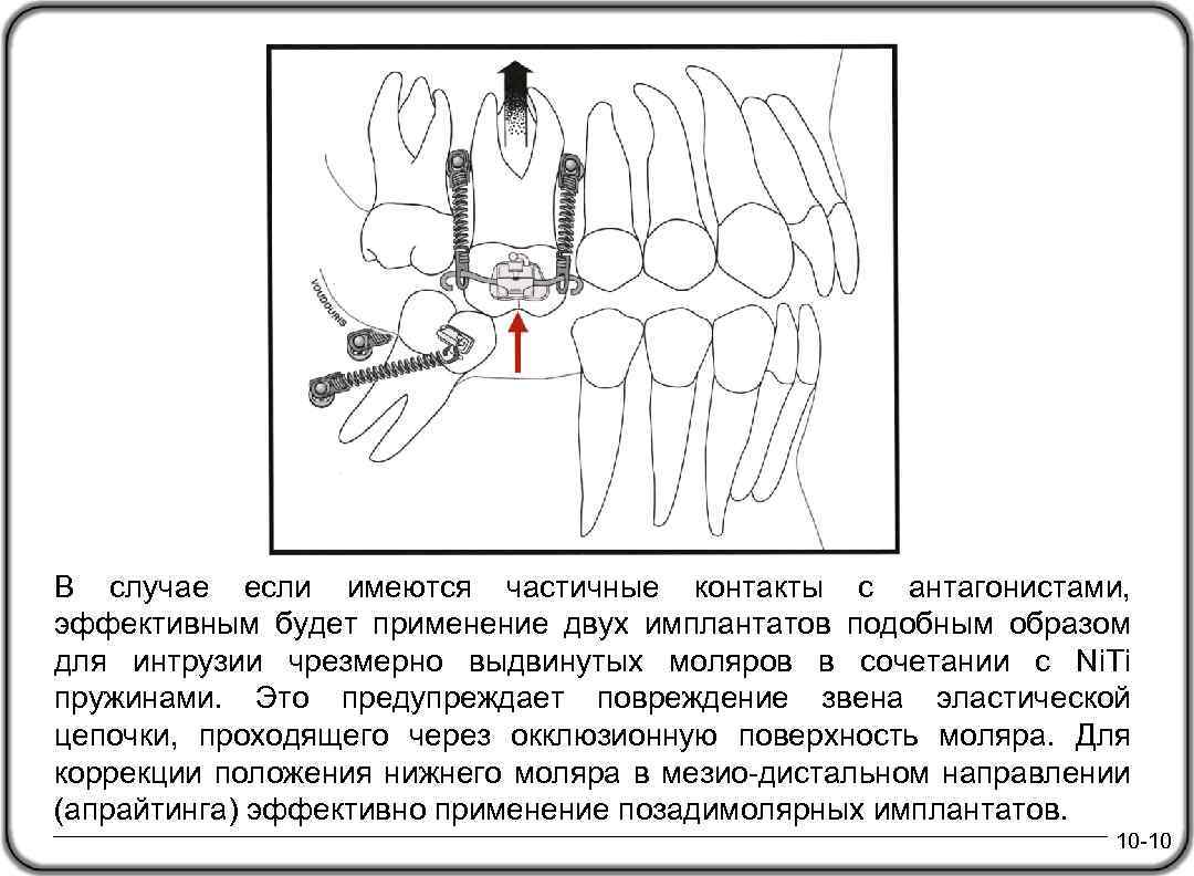 В случае если имеются частичные контакты с антагонистами, эффективным будет применение двух имплантатов подобным