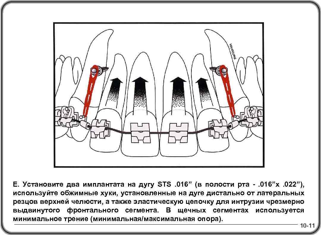 Е. Установите два имплантата на дугу STS. 016” (в полости рта -. 016”x. 022”),