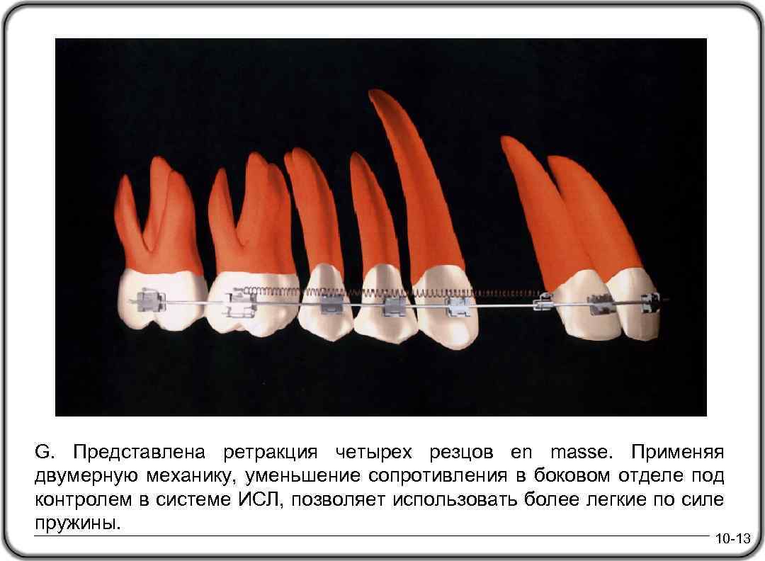G. Представлена ретракция четырех резцов en masse. Применяя двумерную механику, уменьшение сопротивления в боковом