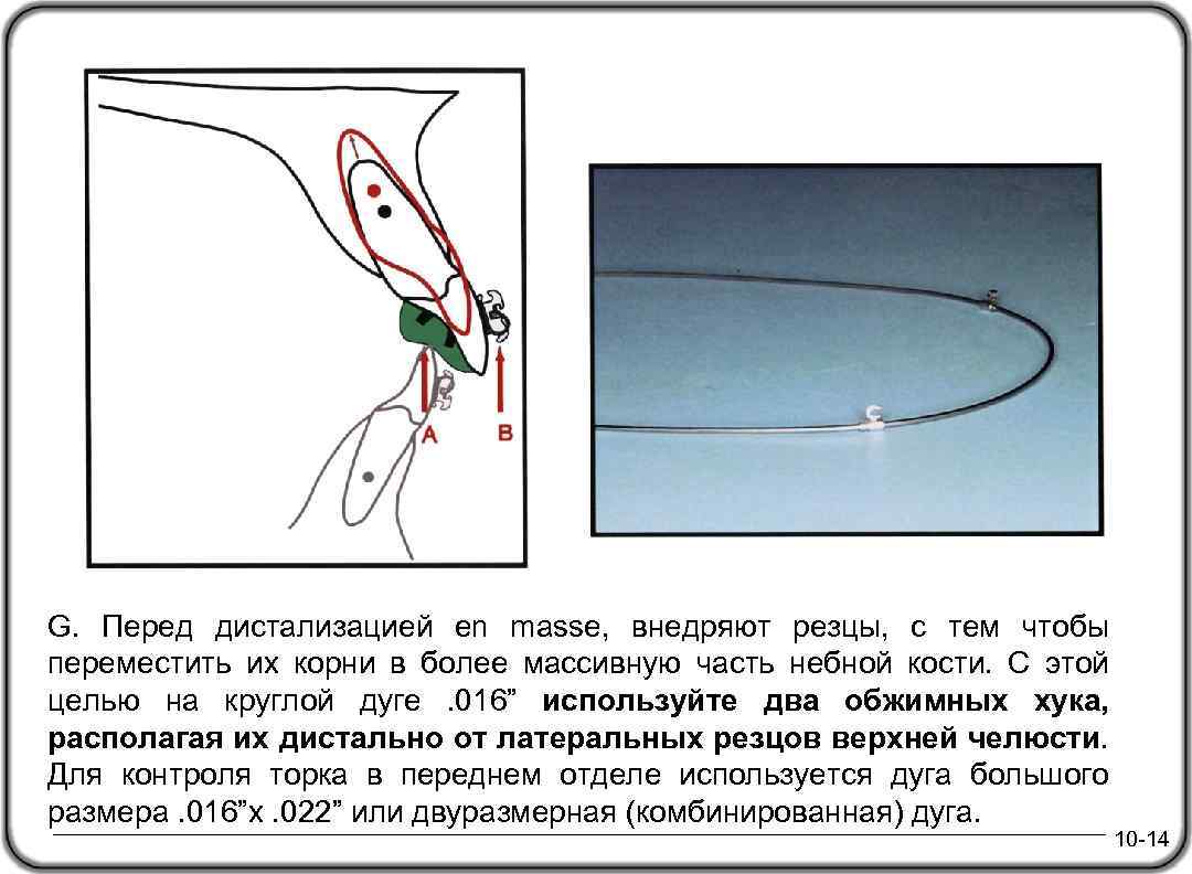 G. Перед дистализацией en masse, внедряют резцы, с тем чтобы переместить их корни в