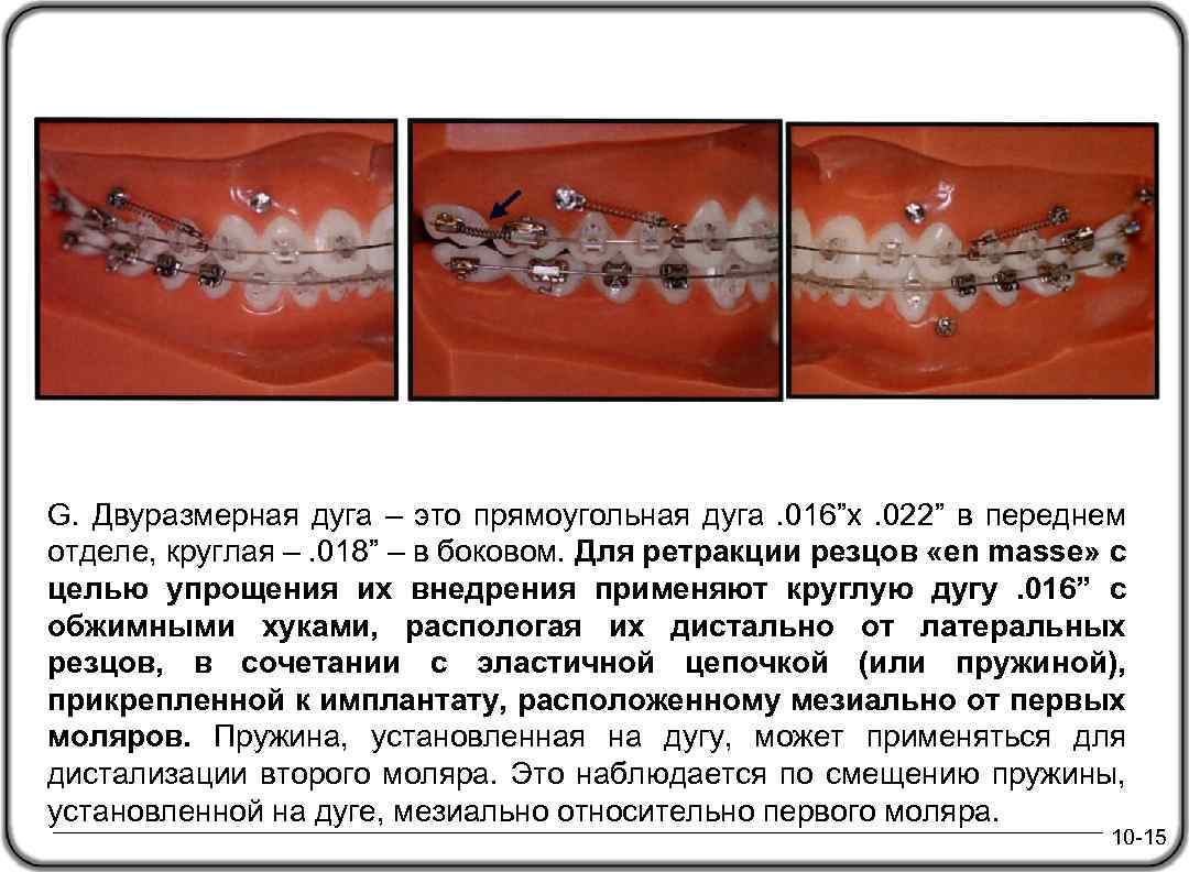 G. Двуразмерная дуга – это прямоугольная дуга. 016”x. 022” в переднем отделе, круглая –.
