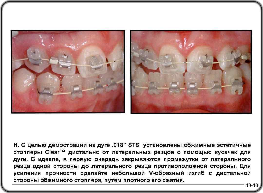 Н. С целью демострации на дуге. 018” STS установлены обжимные эстетичные стопперы Clear™ дистально