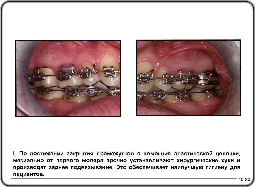 I. По достижении закрытия промежутков с помощью эластической цепочки, мезиально от первого моляра прочно