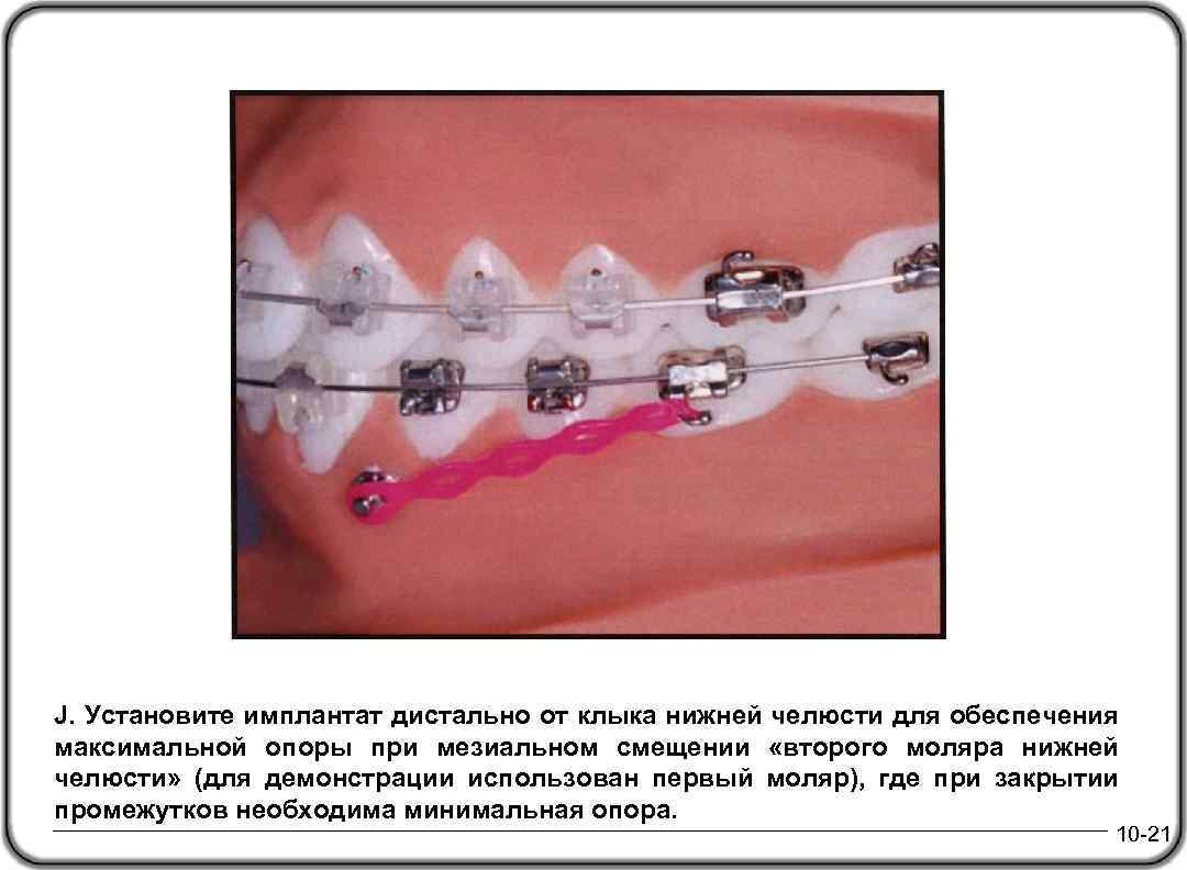 J. Установите имплантат дистально от клыка нижней челюсти для обеспечения максимальной опоры при мезиальном