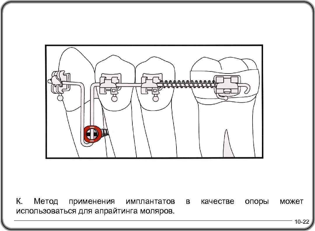 К. Метод применения имплантатов использоваться для апрайтинга моляров. в качестве опоры может 10 -22