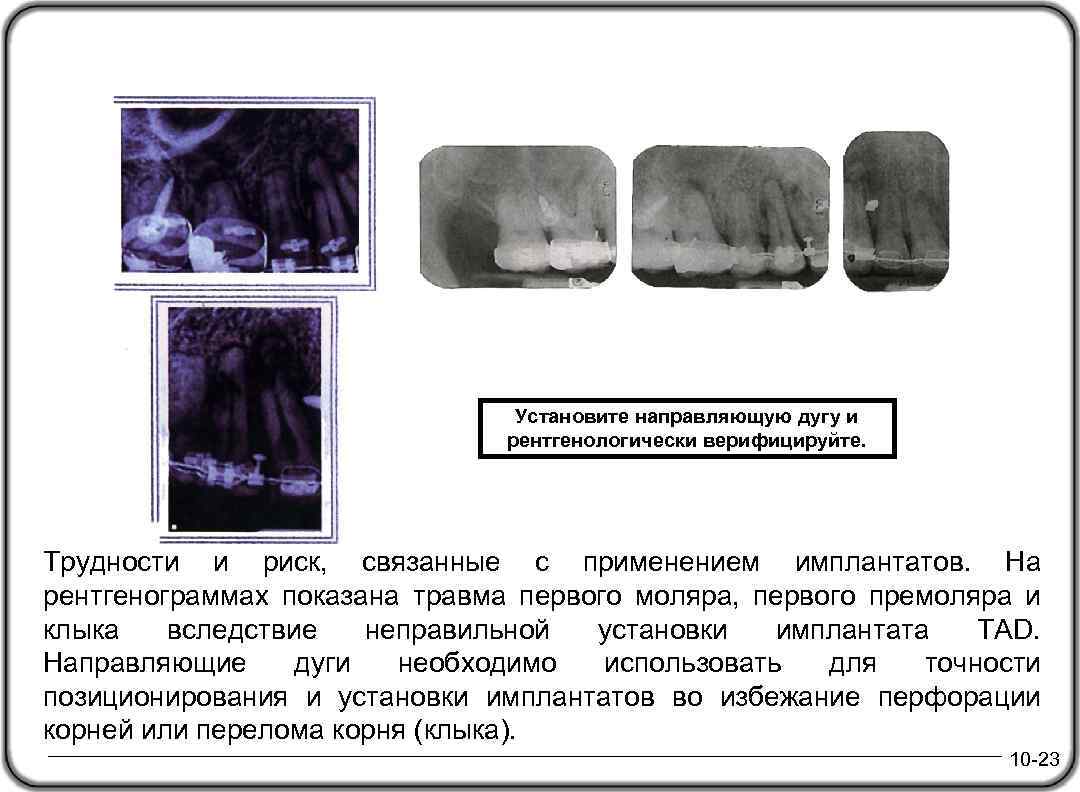 Установите направляющую дугу и рентгенологически верифицируйте. Трудности и риск, связанные с применением имплантатов. На