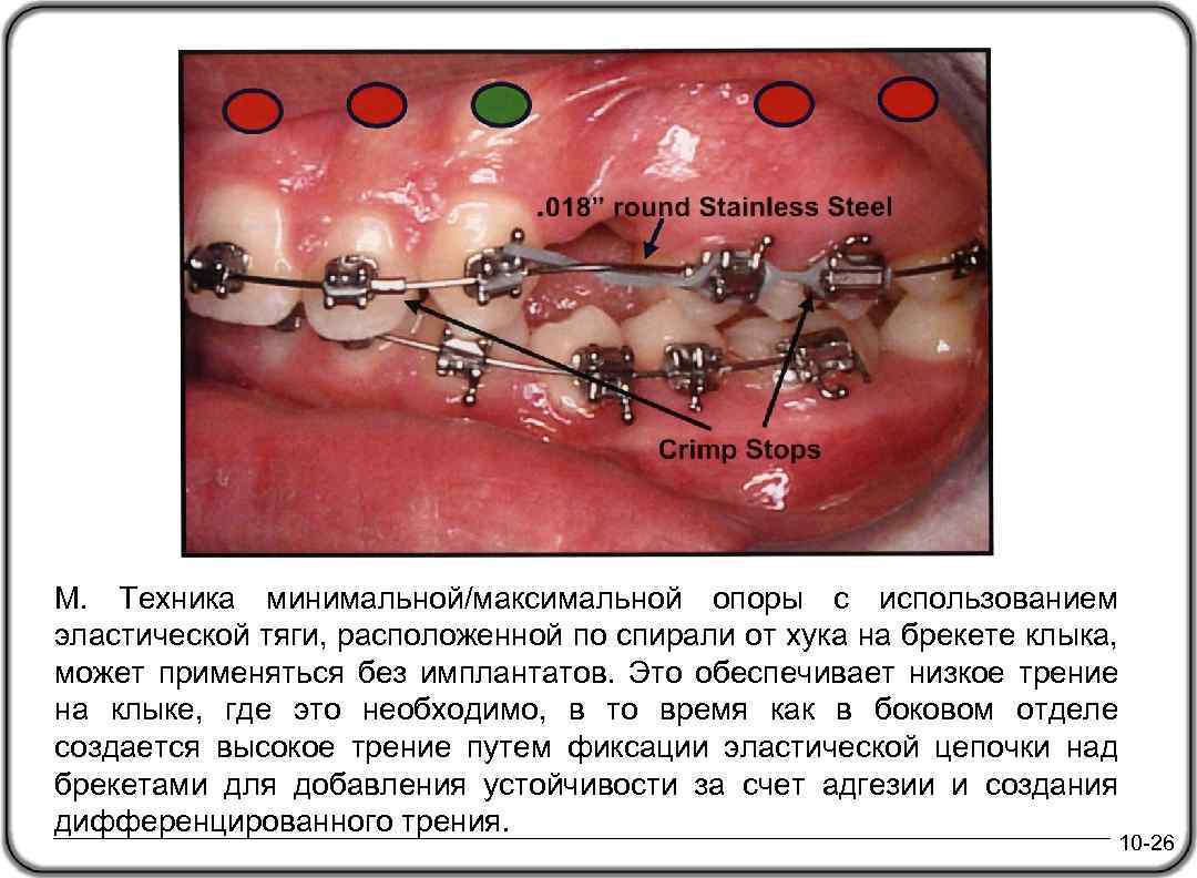 М. Техника минимальной/максимальной опоры с использованием эластической тяги, расположенной по спирали от хука на
