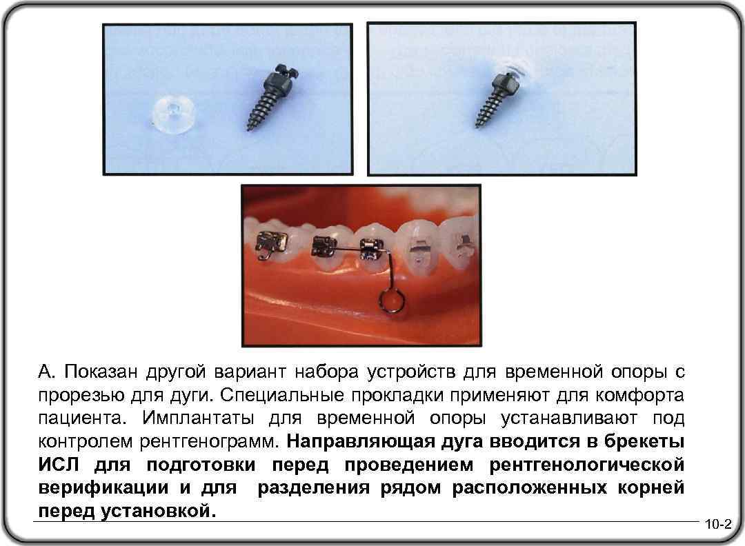 А. Показан другой вариант набора устройств для временной опоры с прорезью для дуги. Специальные