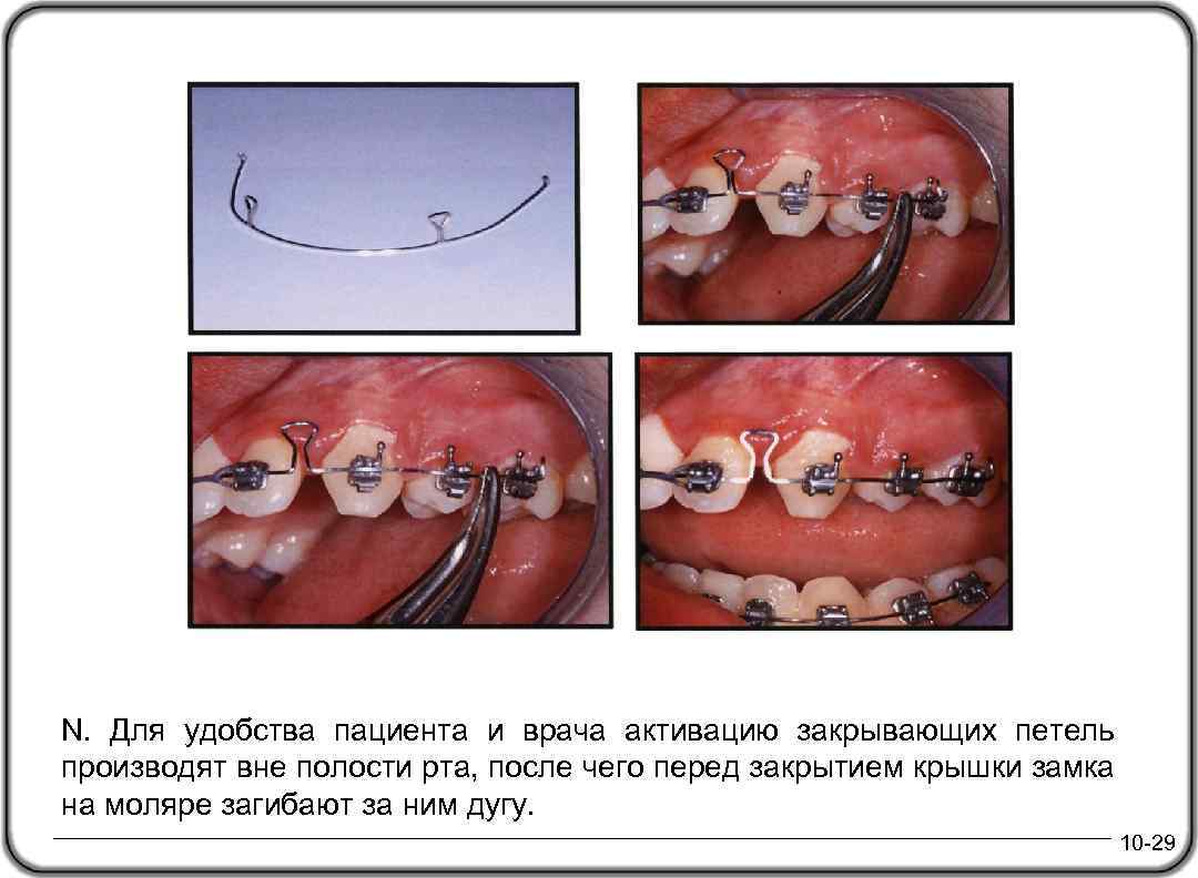 N. Для удобства пациента и врача активацию закрывающих петель производят вне полости рта, после