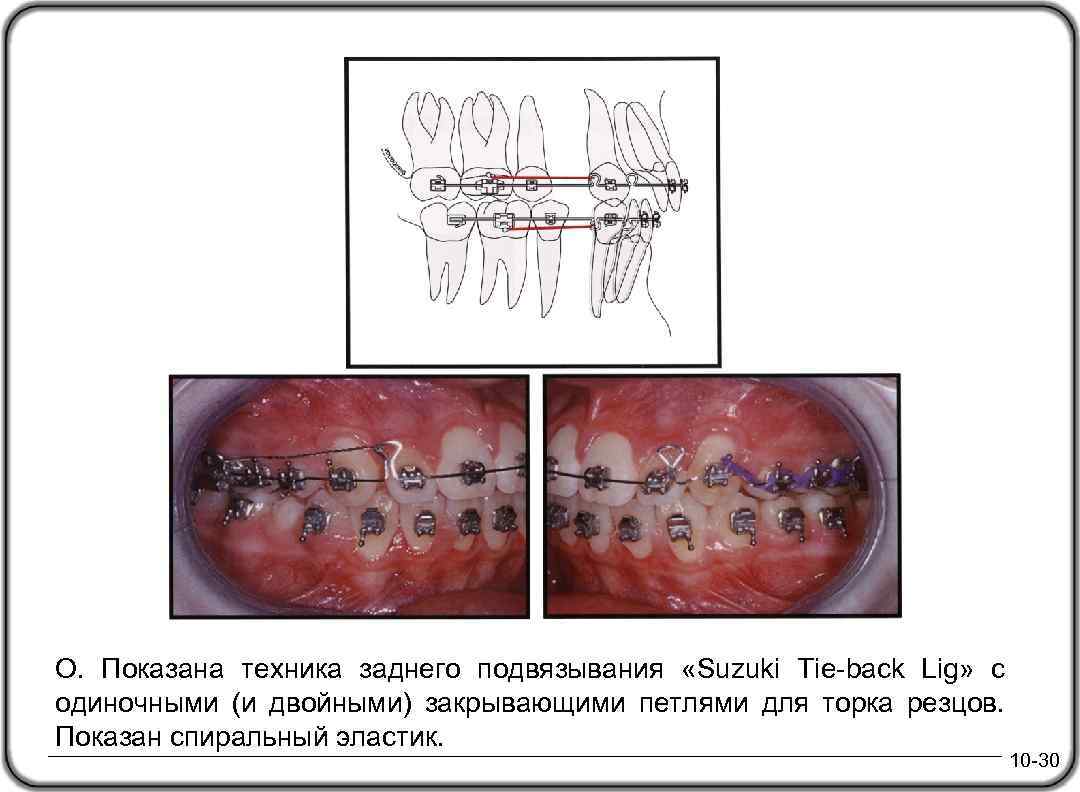 О. Показана техника заднего подвязывания «Suzuki Tie-back Lig» с одиночными (и двойными) закрывающими петлями