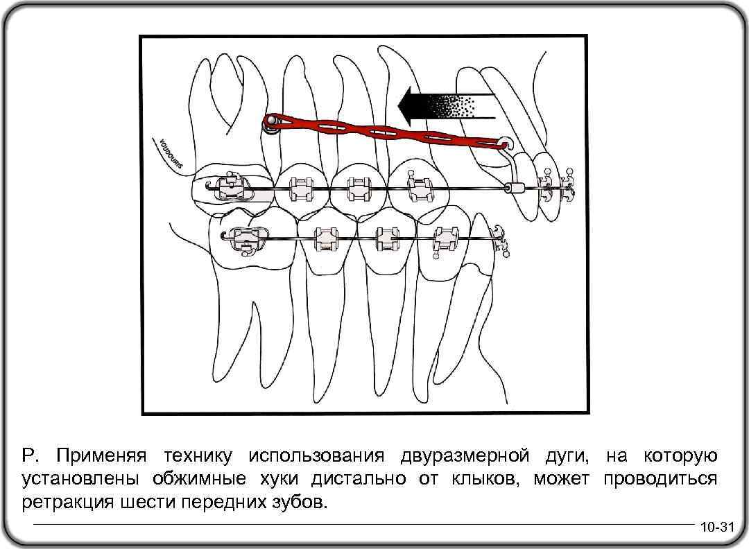 Р. Применяя технику использования двуразмерной дуги, на которую установлены обжимные хуки дистально от клыков,