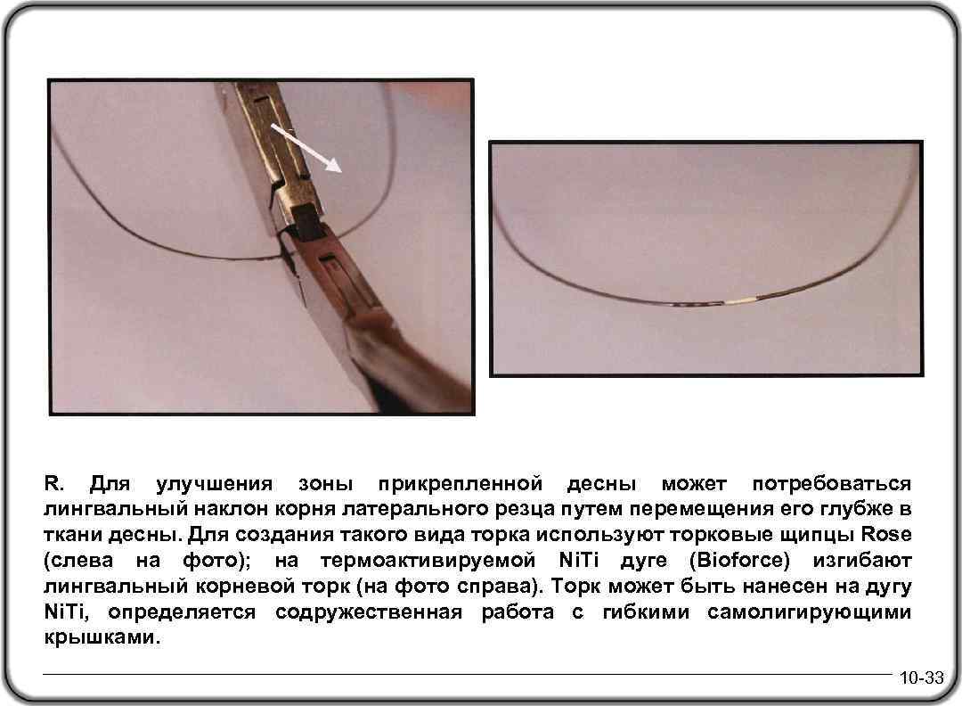 R. Для улучшения зоны прикрепленной десны может потребоваться лингвальный наклон корня латерального резца путем