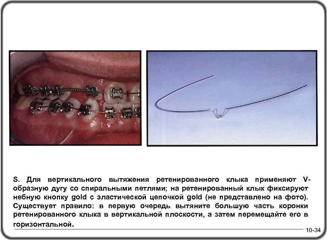 Long V-Bend Wire вытяжения ретенированного S. Для вертикального клыка применяют Vобразную дугу со спиральными