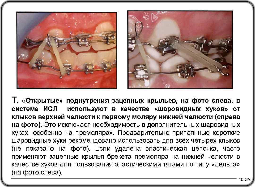 Т. «Открытые» поднутрения зацепных крыльев, на фото слева, в системе ИСЛ используют в качестве