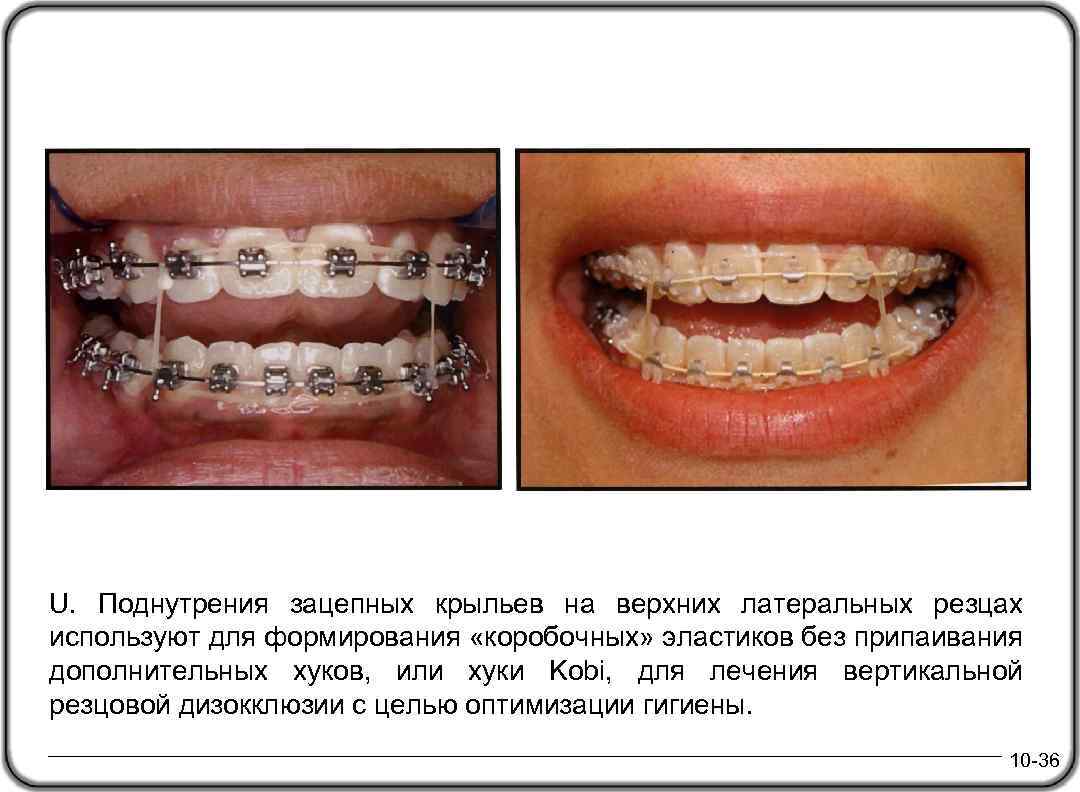 Эластики схемы ношения