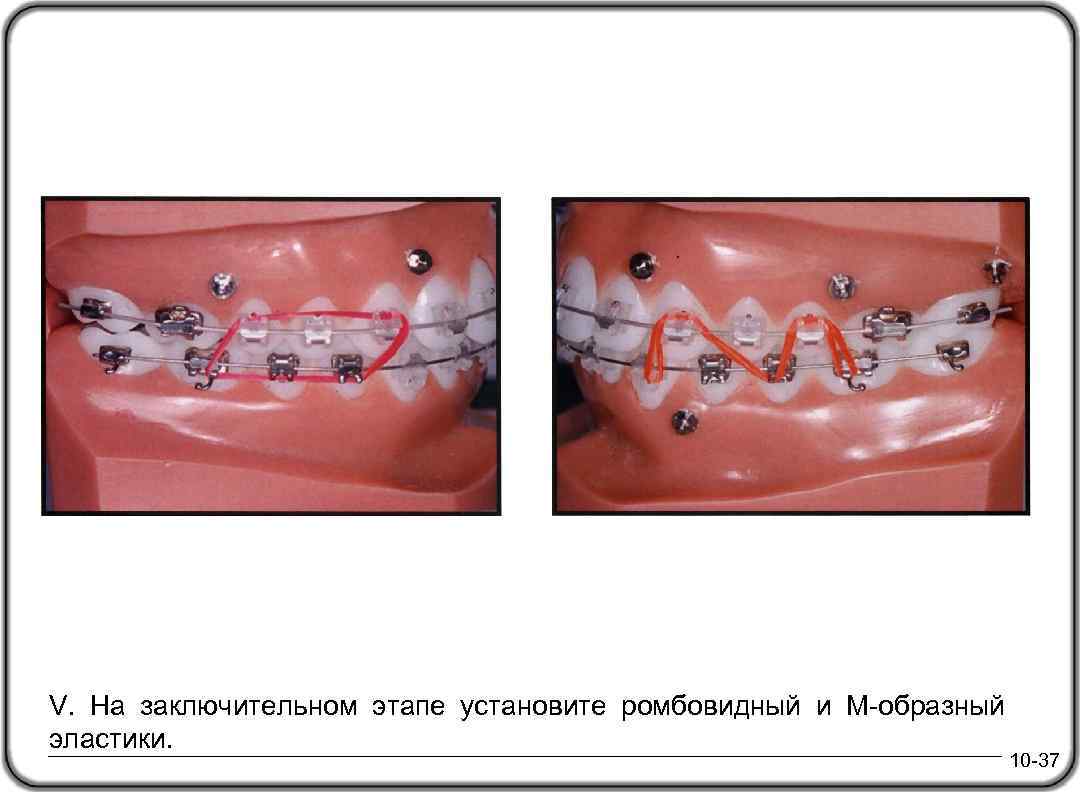 V. На заключительном этапе установите ромбовидный и М-образный эластики. 10 -37 