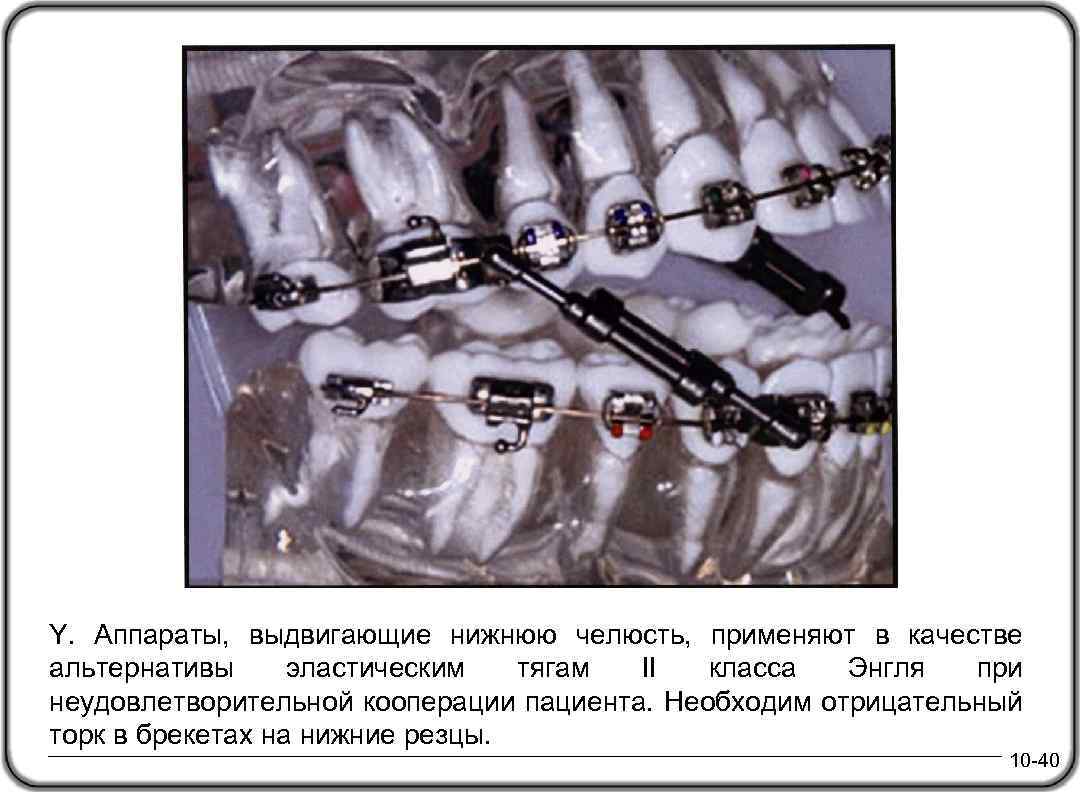 Y. Аппараты, выдвигающие нижнюю челюсть, применяют в качестве альтернативы эластическим тягам II класса Энгля