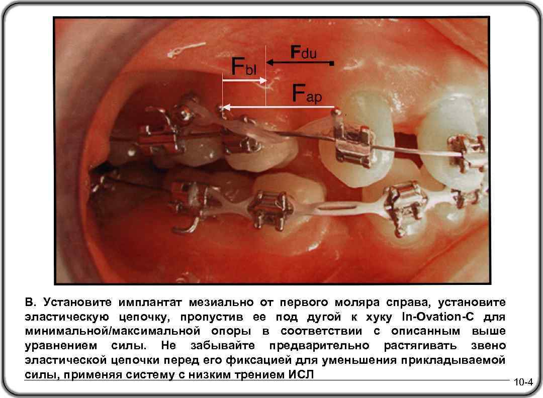 В. Установите имплантат мезиально от первого моляра справа, установите эластическую цепочку, пропустив ее под