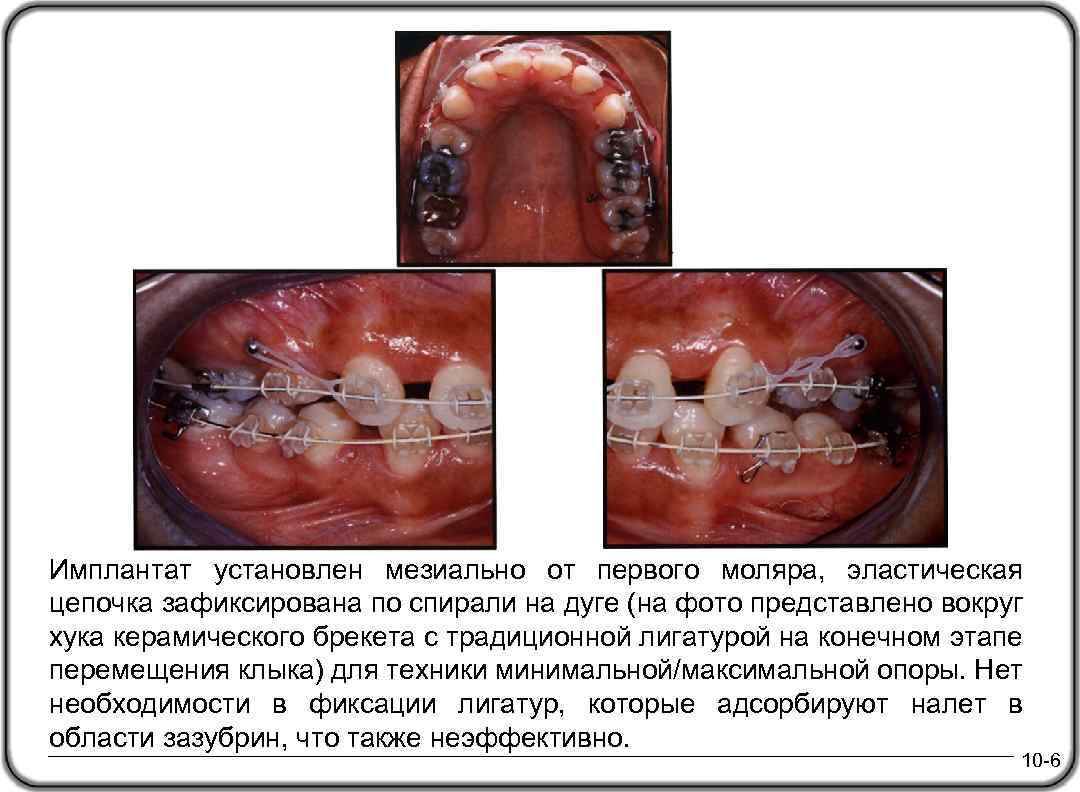 Имплантат установлен мезиально от первого моляра, эластическая цепочка зафиксирована по спирали на дуге (на