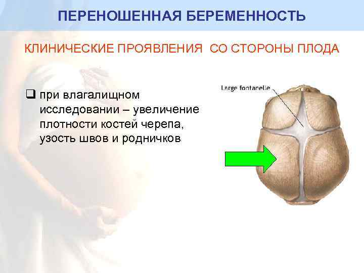 ПЕРЕНОШЕННАЯ БЕРЕМЕННОСТЬ КЛИНИЧЕСКИЕ ПРОЯВЛЕНИЯ СО СТОРОНЫ ПЛОДА q при влагалищном исследовании – увеличение плотности