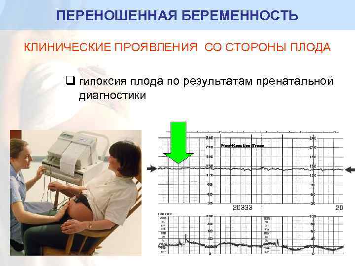 ПЕРЕНОШЕННАЯ БЕРЕМЕННОСТЬ КЛИНИЧЕСКИЕ ПРОЯВЛЕНИЯ СО СТОРОНЫ ПЛОДА q гипоксия плода по результатам пренатальной диагностики