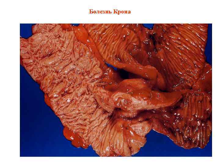 Болезнь Крона 