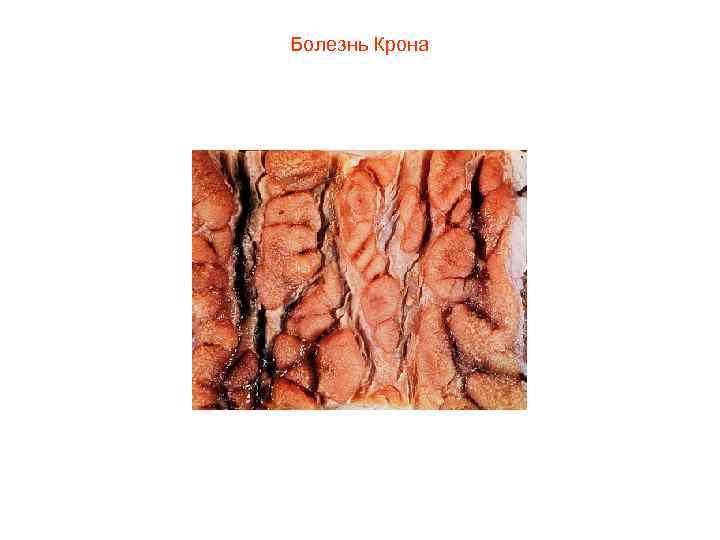 Болезнь Крона 