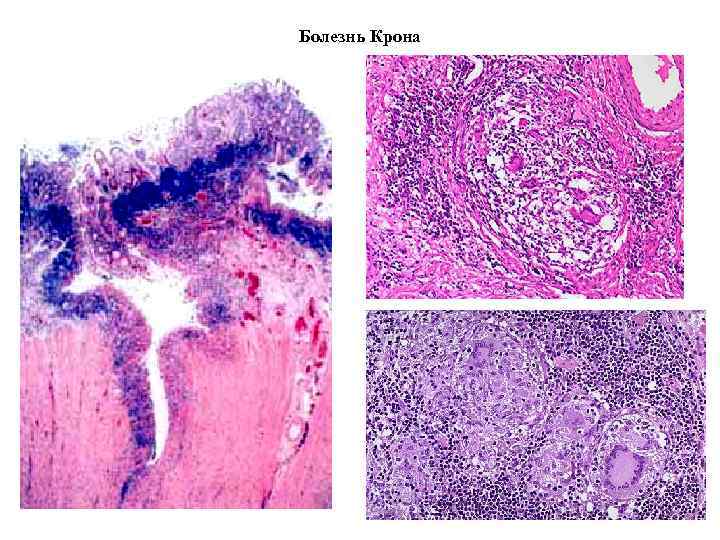 Болезнь Крона 