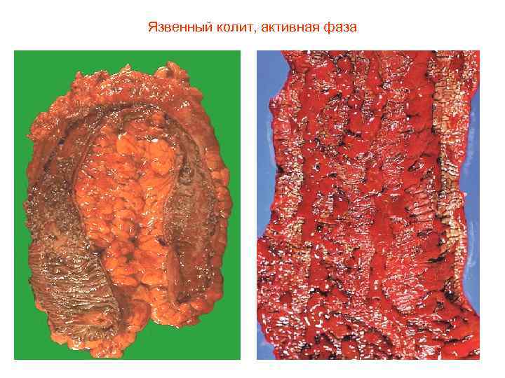 Язвенный колит, активная фаза 