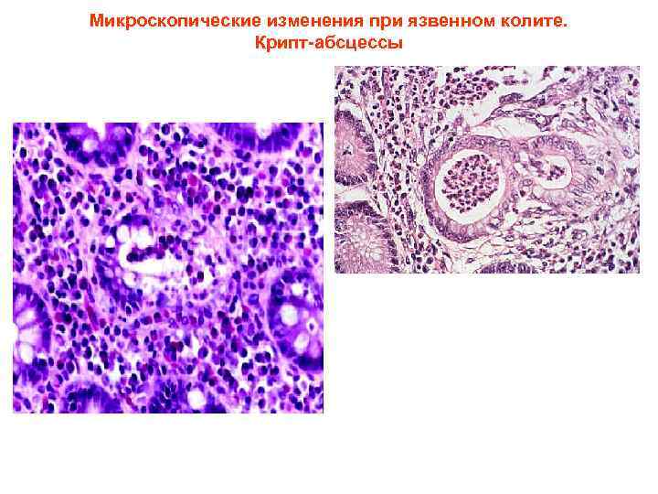 Микроскопические изменения при язвенном колите. Крипт-абсцессы 